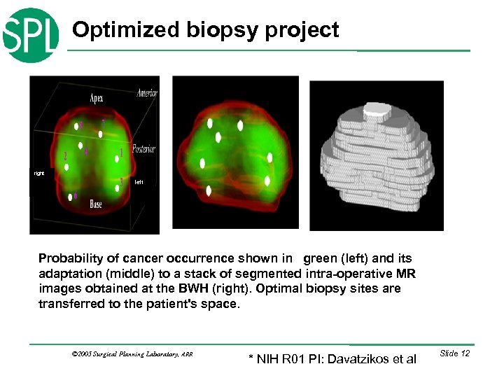 Optimized biopsy project right left Probability of cancer occurrence shown in green (left) and