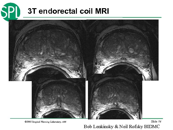 3 T endorectal coil MRI © 2005 Surgical Planning Laboratory, ARR Slide 14 Bob