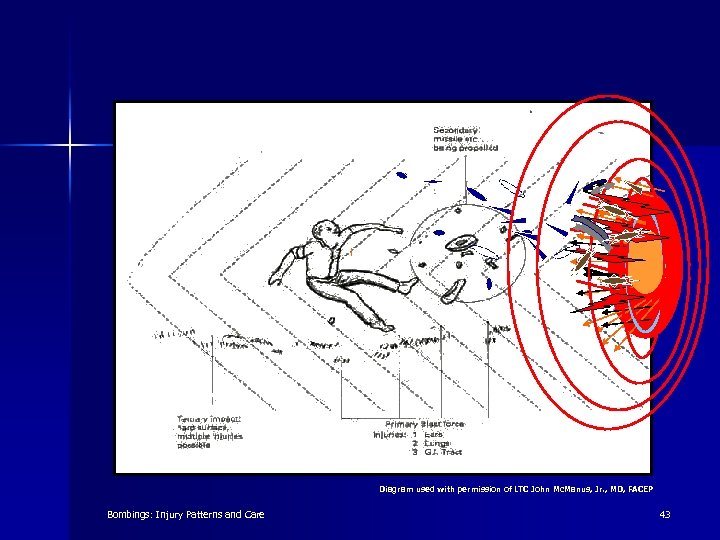 Diagram used with permission of LTC John Mc. Manus, Jr. , MD, FACEP Bombings: