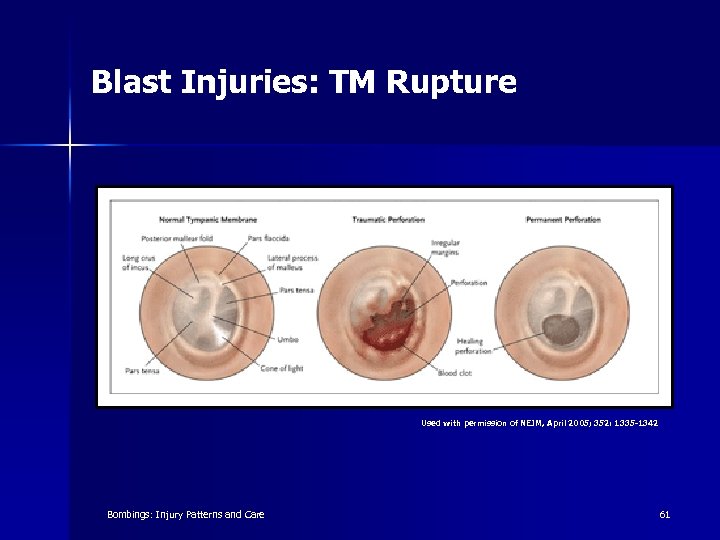 Blast Injuries: TM Rupture Used with permission of NEJM, April 2005; 352: 1335 -1342