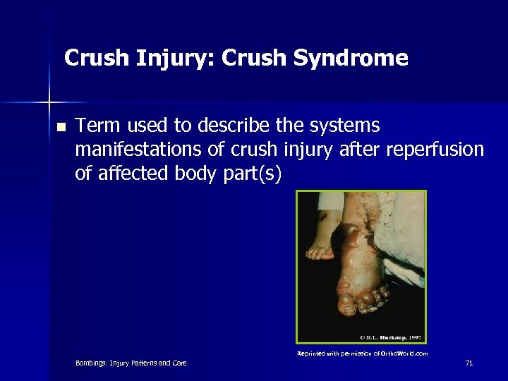 Crush Injury: Crush Syndrome n Term used to describe the systems manifestations of crush