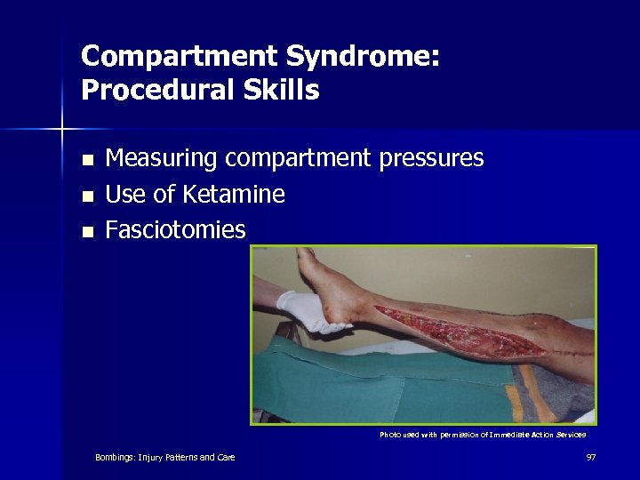 Compartment Syndrome: Procedural Skills n n n Measuring compartment pressures Use of Ketamine Fasciotomies