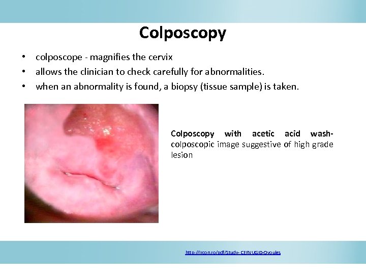 Colposcopy • colposcope - magnifies the cervix • allows the clinician to check carefully