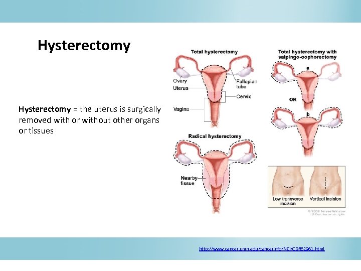 Hysterectomy = the uterus is surgically removed with or without other organs or tissues