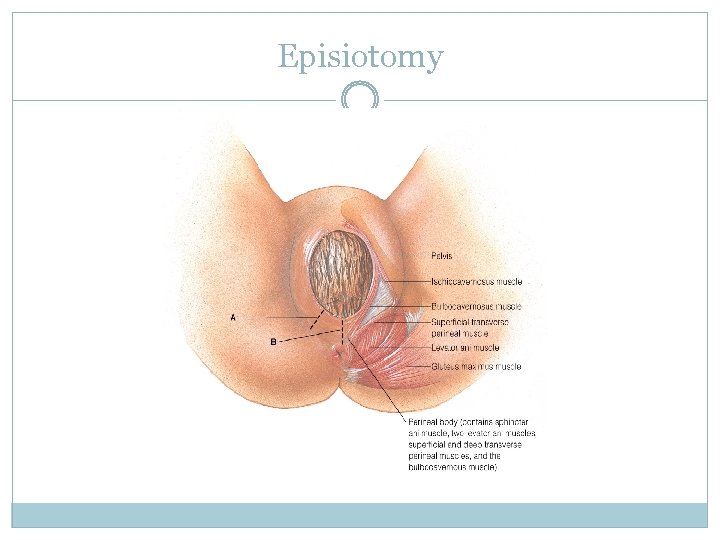 Episiotomy 
