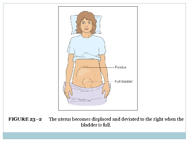 FIGURE 23– 2 The uterus becomes displaced and deviated to the right when the