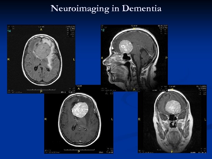 Neuroimaging in Dementia 