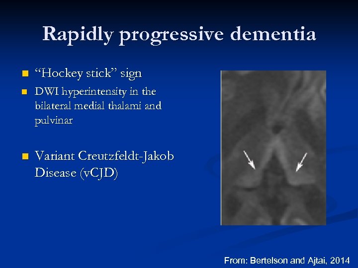 Rapidly progressive dementia n “Hockey stick” sign n DWI hyperintensity in the bilateral medial