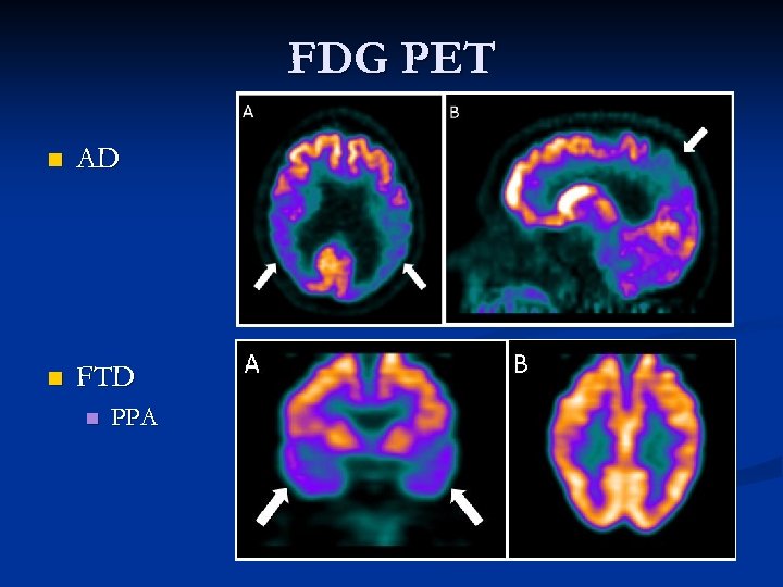 FDG PET n AD n FTD n PPA 