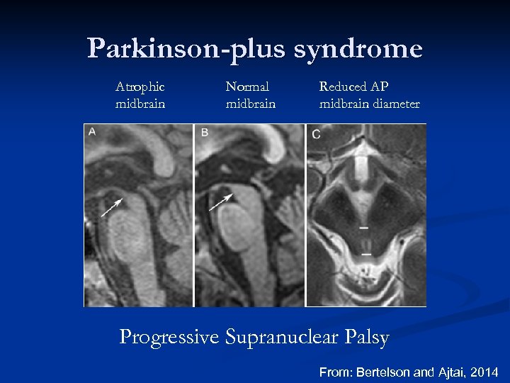 Parkinson-plus syndrome Atrophic midbrain Normal midbrain Reduced AP midbrain diameter Progressive Supranuclear Palsy From: