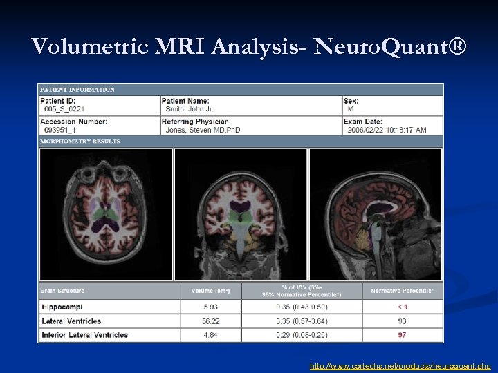 Volumetric MRI Analysis- Neuro. Quant® http: //www. cortechs. net/products/neuroquant. php 