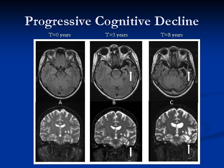 Progressive Cognitive Decline T=0 years T=3 years T=8 years 