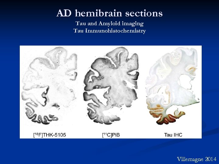 AD hemibrain sections Tau and Amyloid imaging Tau Immunohistochemistry Villemagne 2014 