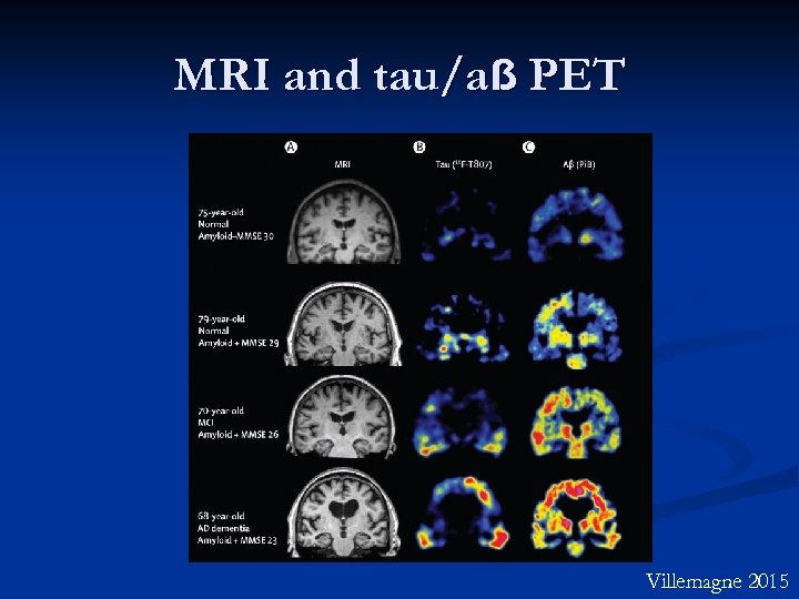 MRI and tau/aẞ PET Villemagne 2015 