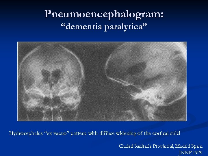 Pneumoencephalogram: “dementia paralytica” Hydrocephalus “ex vacuo” pattern with diffuse widening of the cortical sulci