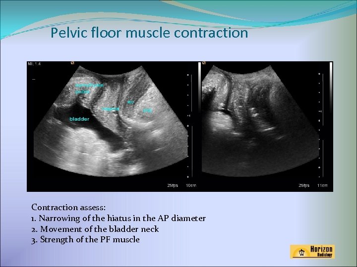 Pelvic floor muscle contraction Contraction assess: 1. Narrowing of the hiatus in the AP