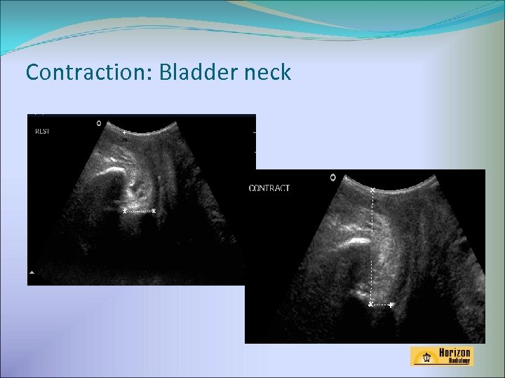 Contraction: Bladder neck 