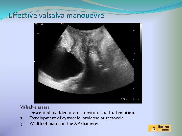 Effective valsalva manouevre Valsalva assess: 1. Descent of bladder, uterus, rectum. Urethral rotation. 2.