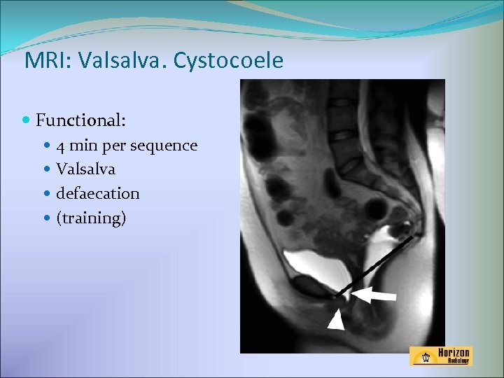 MRI: Valsalva. Cystocoele Functional: 4 min per sequence Valsalva defaecation (training) 