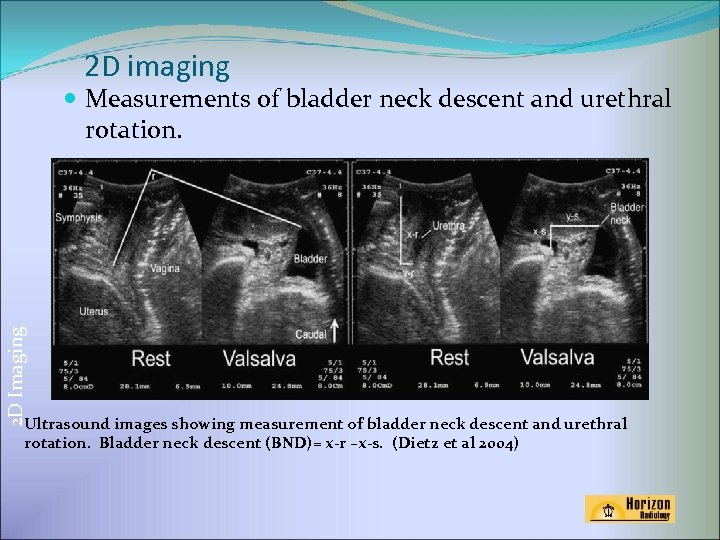 2 D imaging 2 D Imaging Measurements of bladder neck descent and urethral rotation.