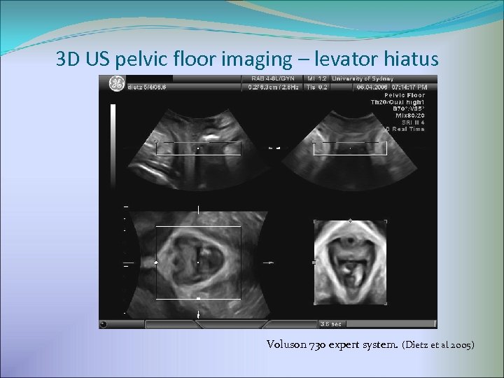 3 D US pelvic floor imaging – levator hiatus Voluson 730 expert system. (Dietz