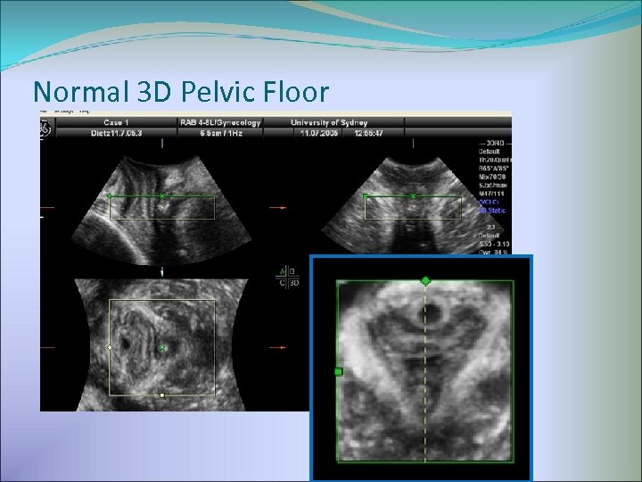 Normal 3 D Pelvic Floor 