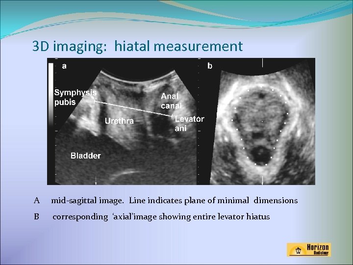 3 D imaging: hiatal measurement A mid-sagittal image. Line indicates plane of minimal dimensions