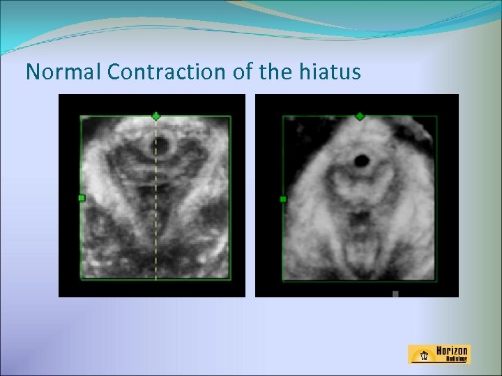 Normal Contraction of the hiatus 