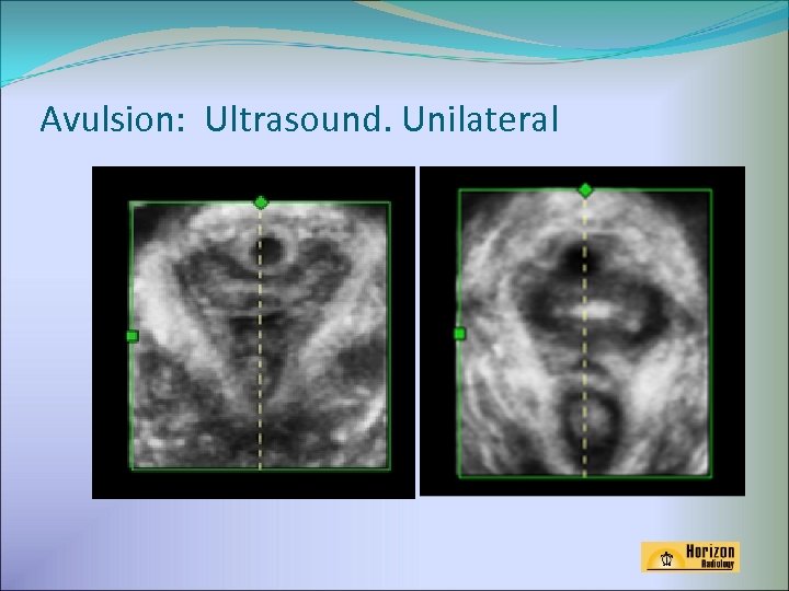 Avulsion: Ultrasound. Unilateral 