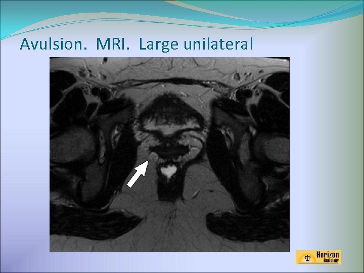 Avulsion. MRI. Large unilateral 