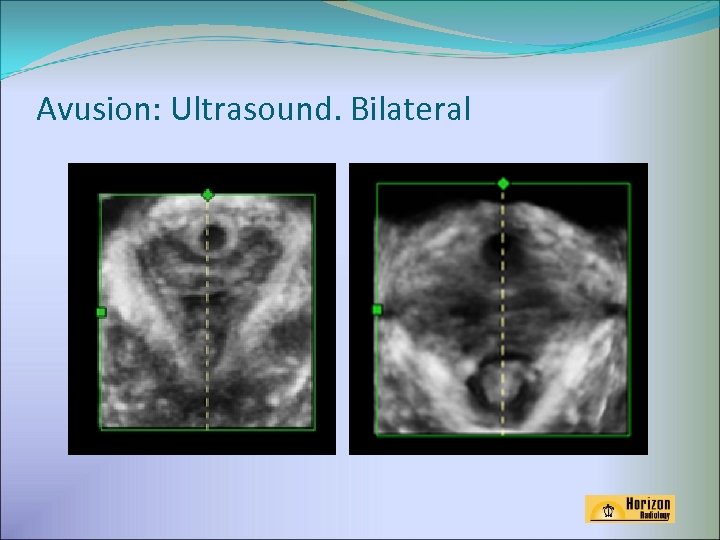 Avusion: Ultrasound. Bilateral 