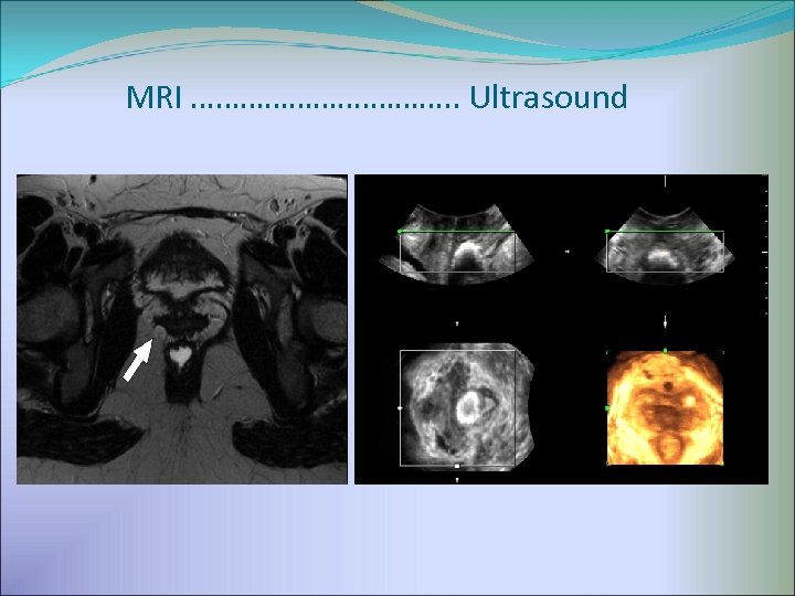 MRI …………………. . Ultrasound 