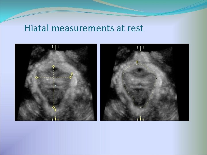 Hiatal measurements at rest 