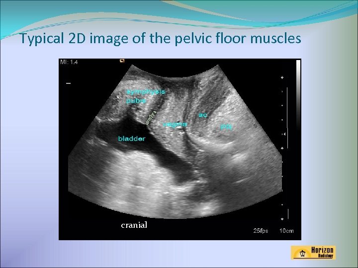 ur eth ra Typical 2 D image of the pelvic floor muscles cranial 