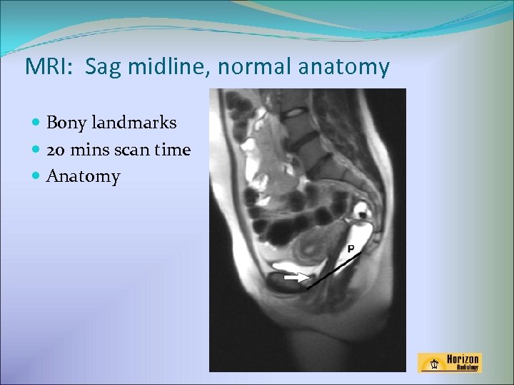 MRI: Sag midline, normal anatomy Bony landmarks 20 mins scan time Anatomy 