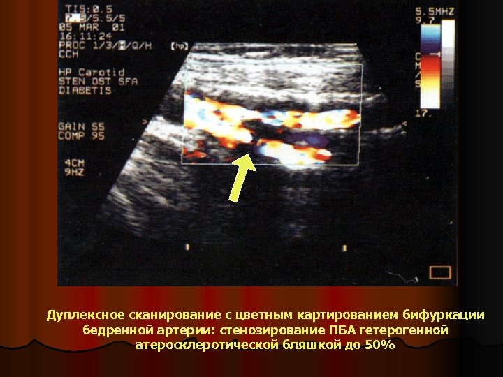 Дуплексное сканирование с цветным картированием бифуркации бедренной артерии: стенозирование ПБА гетерогенной атеросклеротической бляшкой до