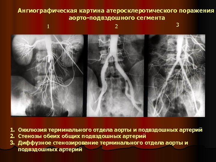 Ангиографическая картина атеросклеротического поражения аорто-подвздошного сегмента 1 2 3 1. Окклюзия терминального отдела аорты