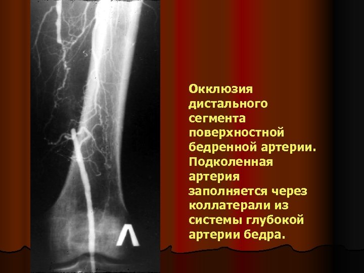 Окклюзия дистального сегмента поверхностной бедренной артерии. Подколенная артерия заполняется через коллатерали из системы глубокой