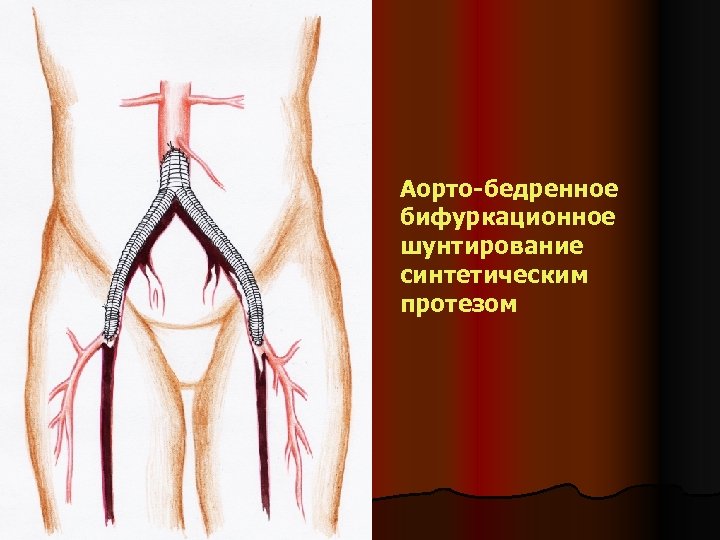 Аорто-бедренное бифуркационное шунтирование синтетическим протезом 