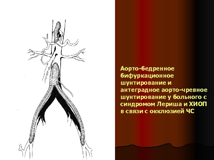 Аорто-бедренное бифуркационное шунтирование и антеградное аорто-чревное шунтирование у больного с синдромом Лериша и ХИОП