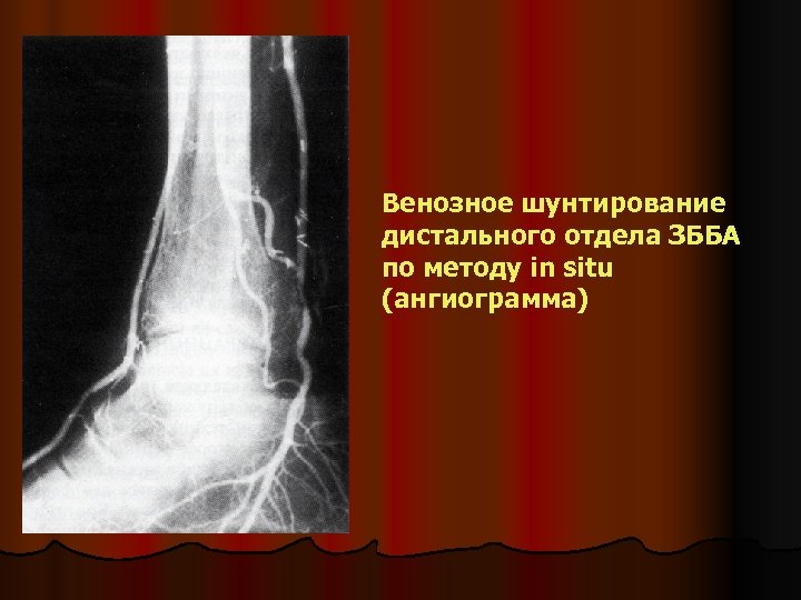 Венозное шунтирование дистального отдела ЗББА по методу in situ (ангиограмма) 