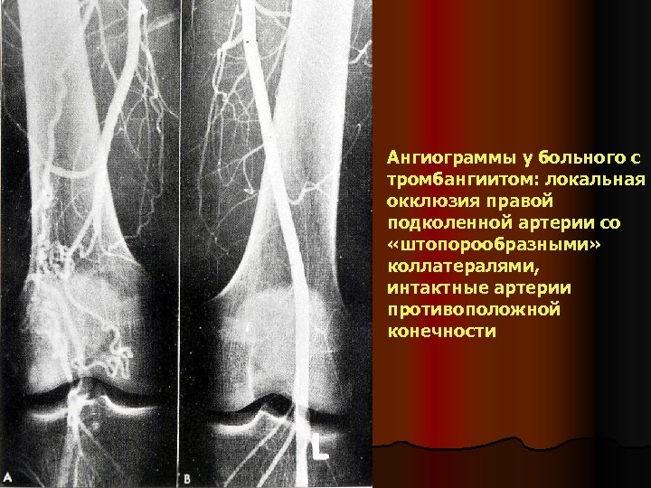 Ангиограммы у больного с тромбангиитом: локальная окклюзия правой подколенной артерии со «штопорообразными» коллатералями, интактные