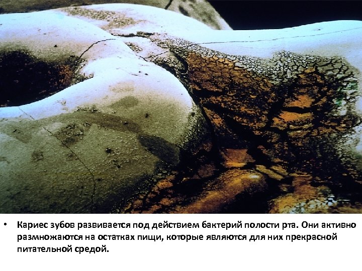  • Кариес зубов развивается под действием бактерий полости рта. Они активно размножаются на