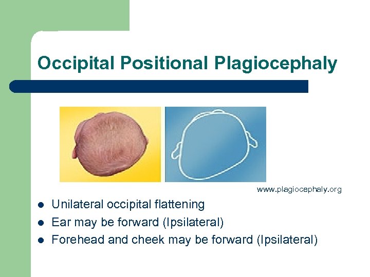 Occipital Positional Plagiocephaly www. plagiocephaly. org l l l Unilateral occipital flattening Ear may