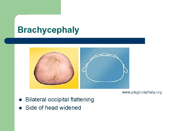 Brachycephaly www. plagiocephaly. org l l Bilateral occipital flattening Side of head widened 
