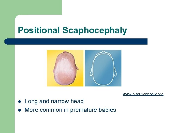 Positional Scaphocephaly www. plagiocephaly. org l l Long and narrow head More common in