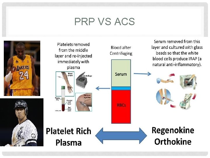 PRP VS ACS 