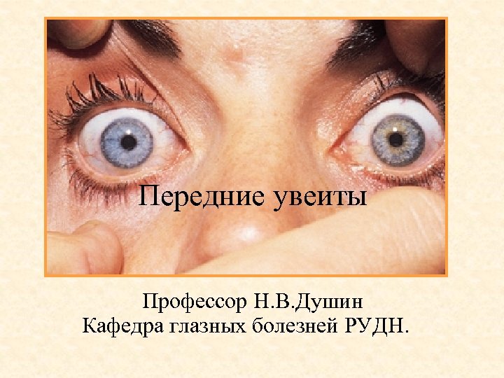 Передние увеиты Профессор Н. В. Душин Кафедра глазных болезней РУДН. 