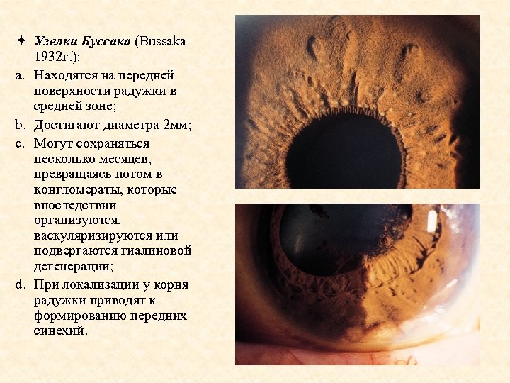 ª Узелки Буссака (Bussaka 1932 г. ): a. Находятся на передней поверхности радужки в