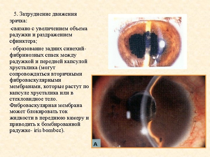 5. Затруднение движения зрачка: -связано с увеличением объема радужки и раздражением сфинктера; - образование
